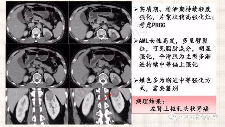 【PPT】乳头状肾细胞癌影像诊断