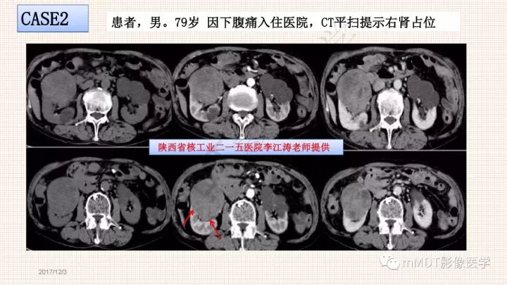 【PPT】乳头状肾细胞癌影像诊断