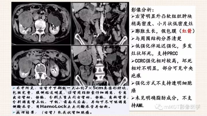 【PPT】乳头状肾细胞癌影像诊断