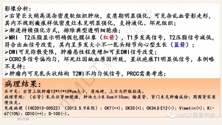 【PPT】乳头状肾细胞癌影像诊断