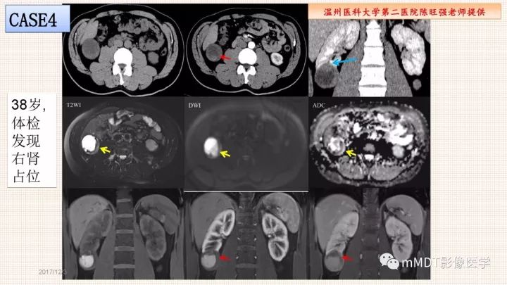 【PPT】乳头状肾细胞癌影像诊断