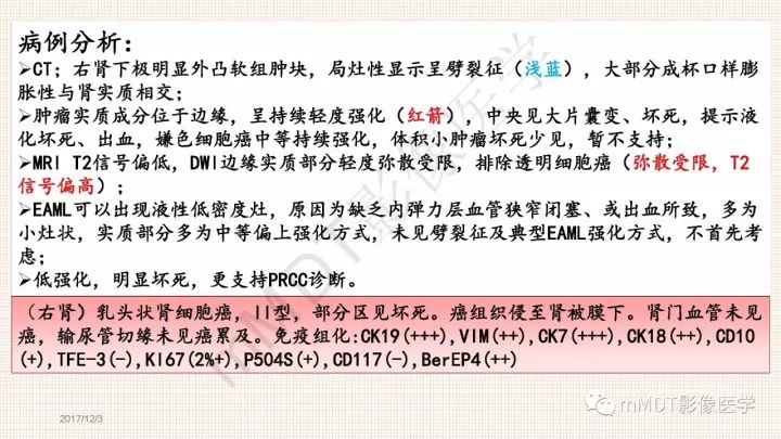 【PPT】乳头状肾细胞癌影像诊断