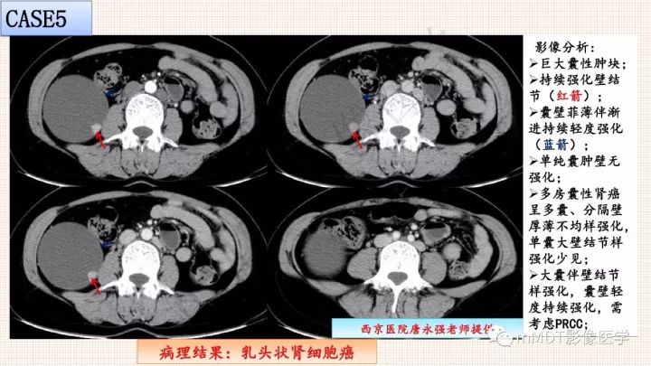 【PPT】乳头状肾细胞癌影像诊断