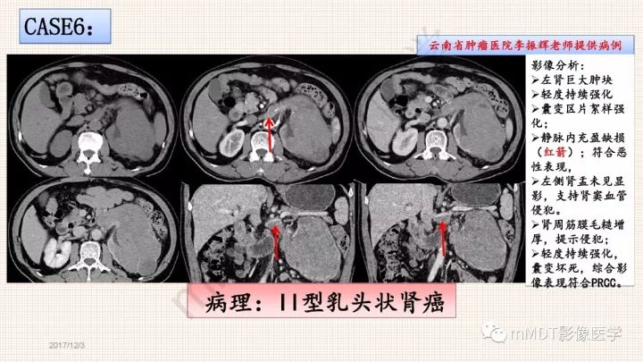 【PPT】乳头状肾细胞癌影像诊断