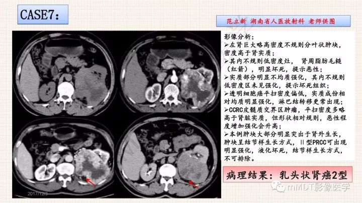 【PPT】乳头状肾细胞癌影像诊断