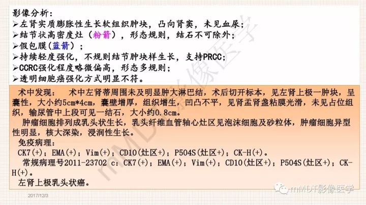 【PPT】乳头状肾细胞癌影像诊断