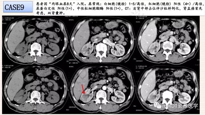 【PPT】乳头状肾细胞癌影像诊断