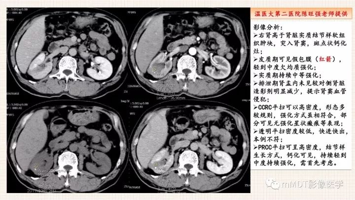 【PPT】乳头状肾细胞癌影像诊断