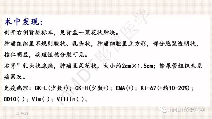 【PPT】乳头状肾细胞癌影像诊断
