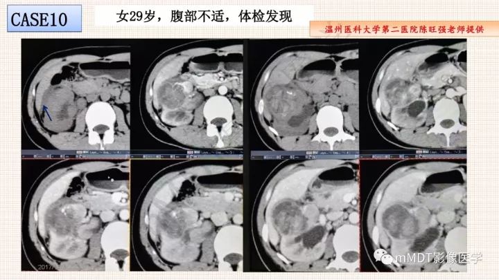 【PPT】乳头状肾细胞癌影像诊断
