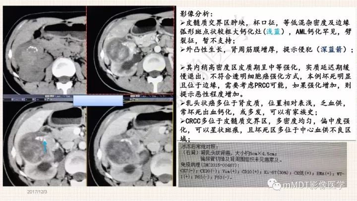 【PPT】乳头状肾细胞癌影像诊断