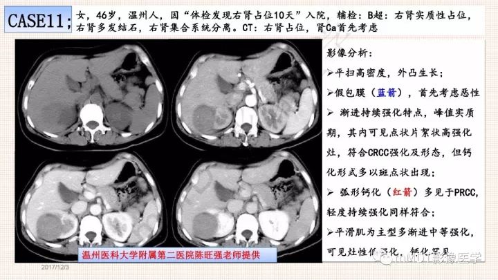 【PPT】乳头状肾细胞癌影像诊断