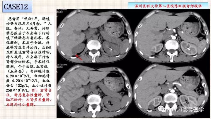 【PPT】乳头状肾细胞癌影像诊断