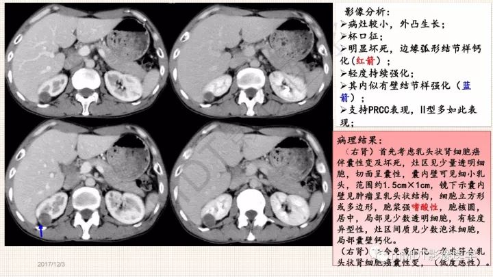 【PPT】乳头状肾细胞癌影像诊断