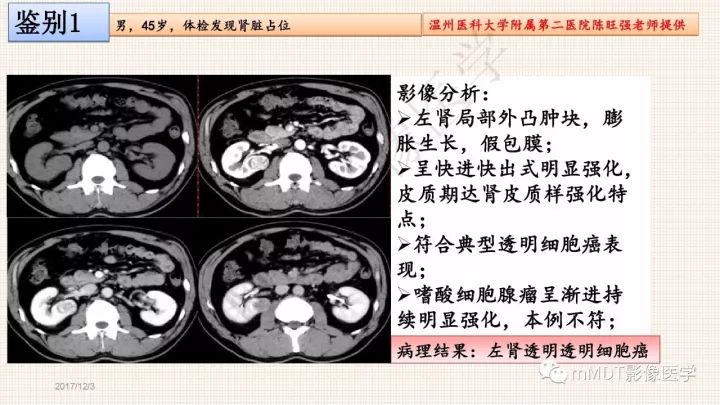【PPT】乳头状肾细胞癌影像诊断