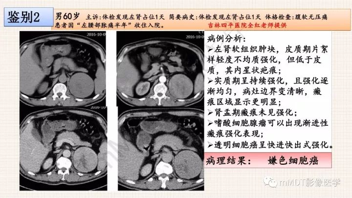 【PPT】乳头状肾细胞癌影像诊断