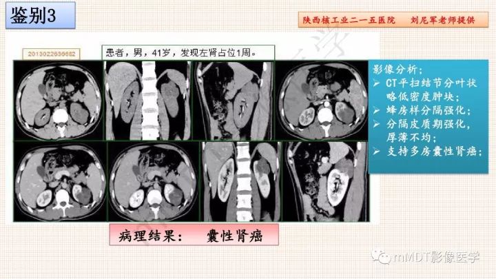 【PPT】乳头状肾细胞癌影像诊断