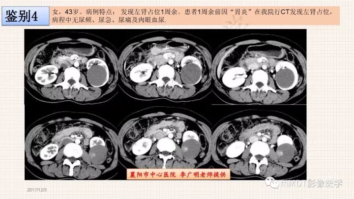 【PPT】乳头状肾细胞癌影像诊断