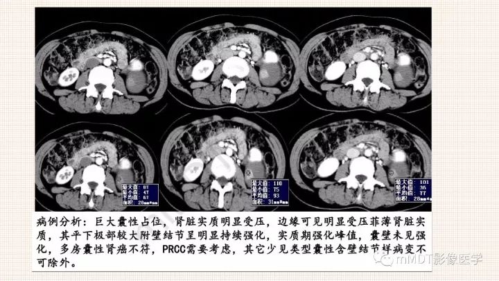 【PPT】乳头状肾细胞癌影像诊断