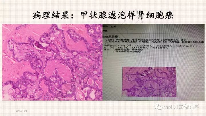 【PPT】乳头状肾细胞癌影像诊断