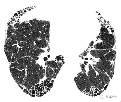 HRCT影像:纤维化和蜂窝样变之类风湿肺病 HRCT影像:纤维化和蜂窝样变之类风湿肺病
