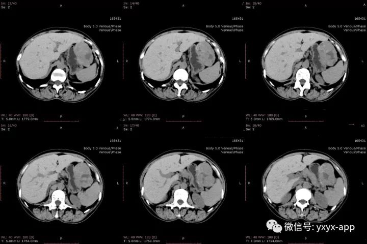 【病例】肝外生性血管瘤1例CT影像表现 【病例】肝外生性血管瘤1例CT影像表现