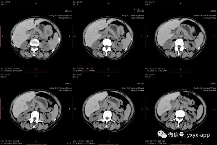 【病例】肝外生性血管瘤1例CT影像表现 【病例】肝外生性血管瘤1例CT影像表现
