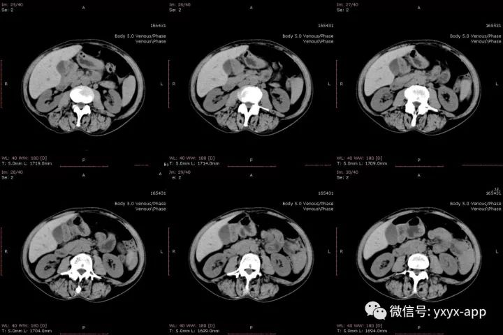 【病例】肝外生性血管瘤1例CT影像表现 【病例】肝外生性血管瘤1例CT影像表现