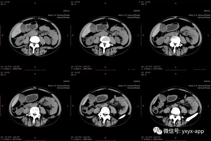 【病例】肝外生性血管瘤1例CT影像表现 【病例】肝外生性血管瘤1例CT影像表现