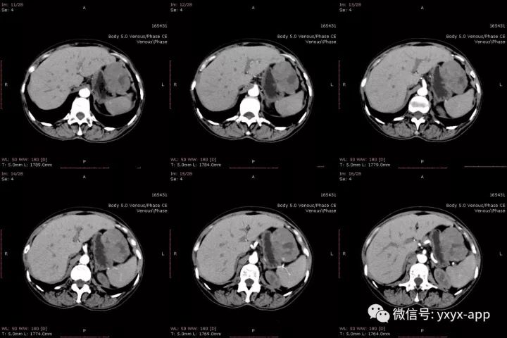【病例】肝外生性血管瘤1例CT影像表现 【病例】肝外生性血管瘤1例CT影像表现