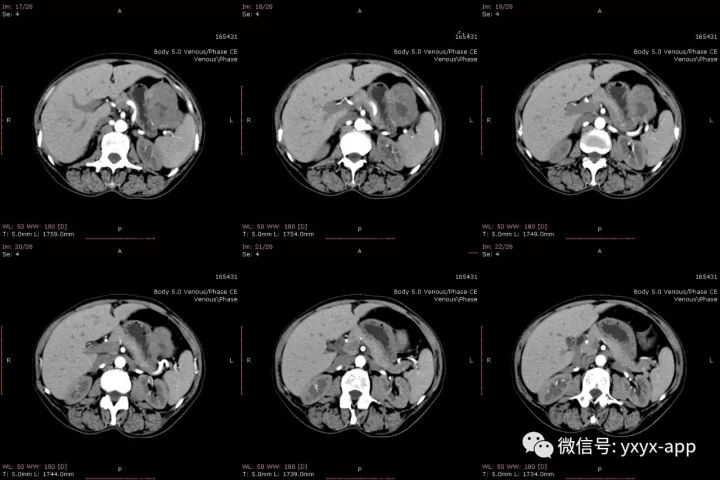 【病例】肝外生性血管瘤1例CT影像表现 【病例】肝外生性血管瘤1例CT影像表现