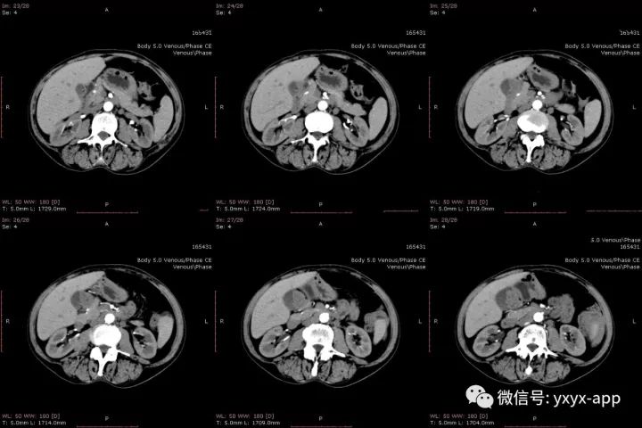 【病例】肝外生性血管瘤1例CT影像表现 【病例】肝外生性血管瘤1例CT影像表现