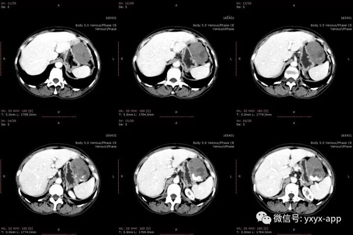 【病例】肝外生性血管瘤1例CT影像表现 【病例】肝外生性血管瘤1例CT影像表现