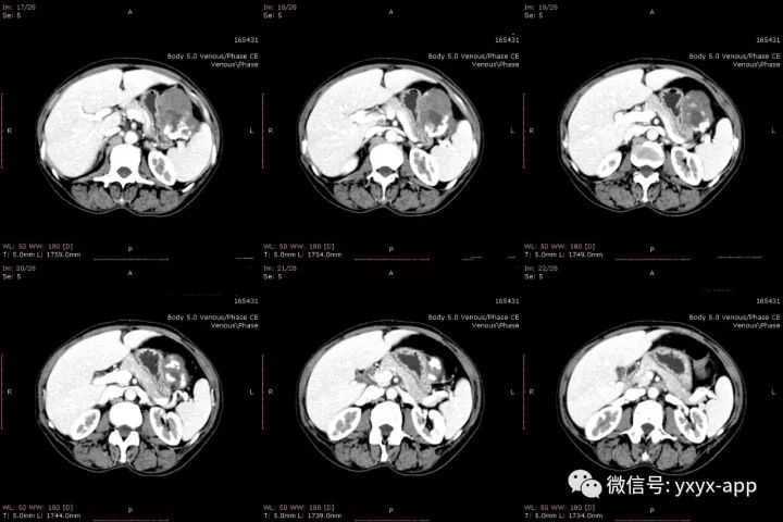 【病例】肝外生性血管瘤1例CT影像表现 【病例】肝外生性血管瘤1例CT影像表现