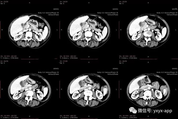 【病例】肝外生性血管瘤1例CT影像表现 【病例】肝外生性血管瘤1例CT影像表现