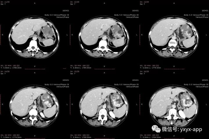 【病例】肝外生性血管瘤1例CT影像表现 【病例】肝外生性血管瘤1例CT影像表现