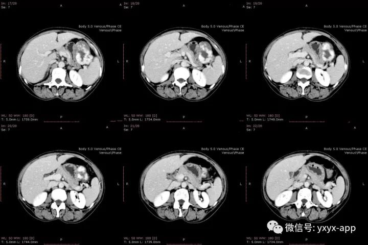 【病例】肝外生性血管瘤1例CT影像表现 【病例】肝外生性血管瘤1例CT影像表现