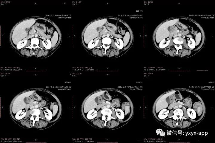 【病例】肝外生性血管瘤1例CT影像表现 【病例】肝外生性血管瘤1例CT影像表现