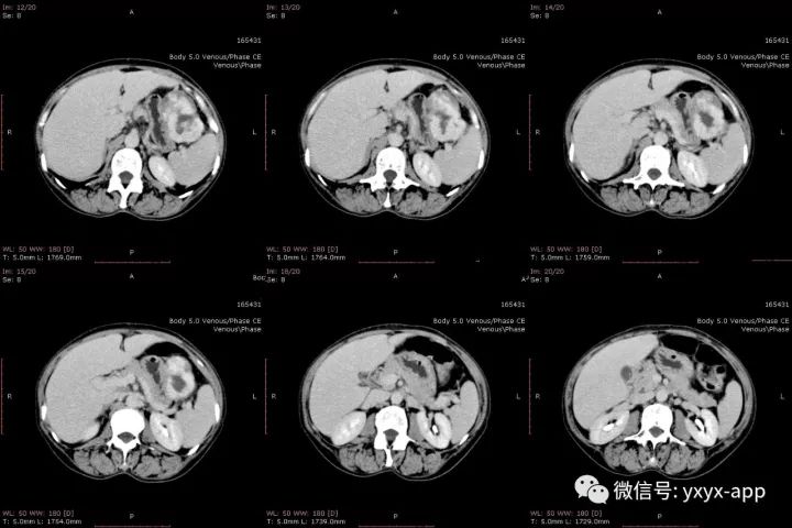 【病例】肝外生性血管瘤1例CT影像表现 【病例】肝外生性血管瘤1例CT影像表现