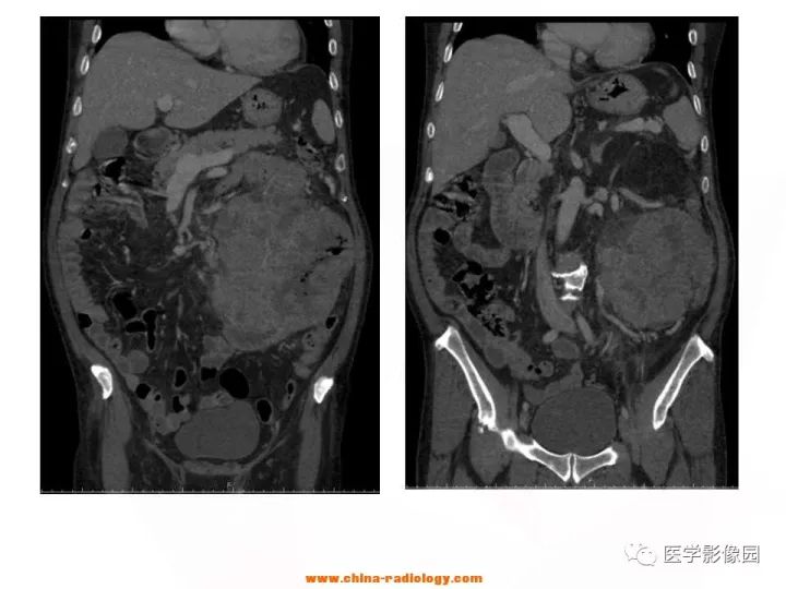 【病例】腹腔恶性间质瘤1例CT影像表现