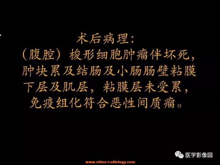 【病例】腹腔恶性间质瘤1例CT影像表现