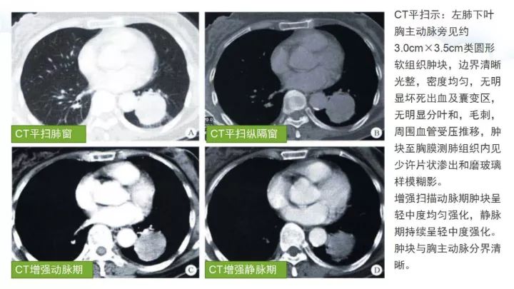 【病例】肺硬化性血管瘤1例CT影像表现