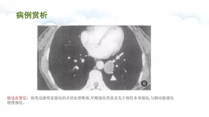 【病例】肺硬化性血管瘤1例CT影像表现