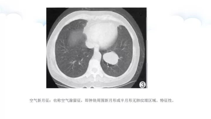 【病例】肺硬化性血管瘤1例CT影像表现