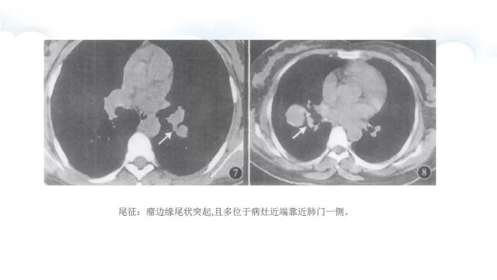 【病例】肺硬化性血管瘤1例CT影像表现