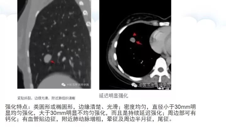 【病例】肺硬化性血管瘤1例CT影像表现