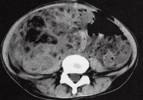 【病例】结节性硬化1例CT影像表现 【病例】结节性硬化1例CT影像表现