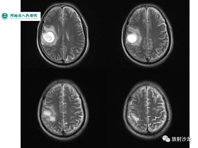 【病例】成人幕上毛细胞型星形细胞瘤1例MR
