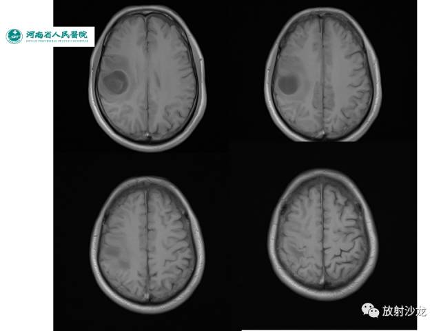【病例】成人幕上毛细胞型星形细胞瘤1例MR