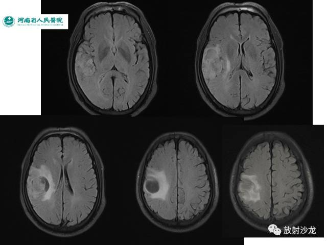 【病例】成人幕上毛细胞型星形细胞瘤1例MR